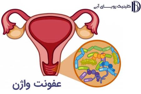 بهترین راه درمان عفونت واژن