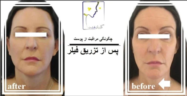 چگونگی مراقبت از پوست پس از تزریق فیلر
