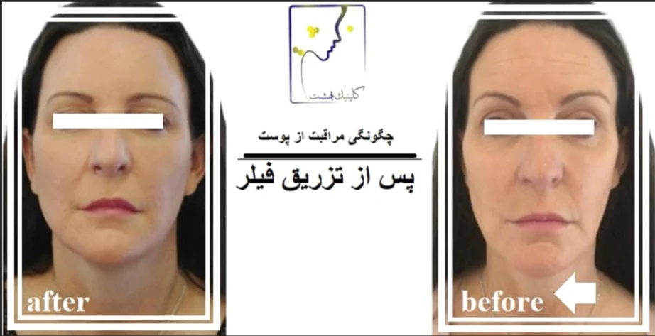 چگونگی مراقبت از پوست پس از تزریق فیلر