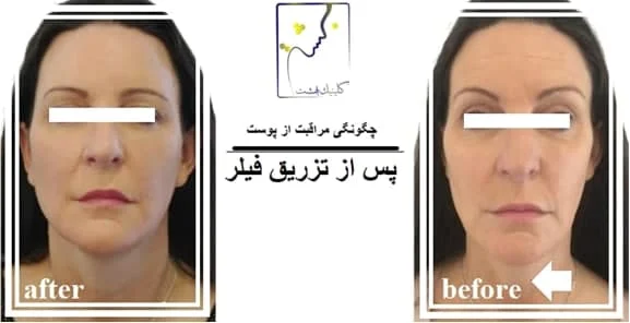پوست چگونگی مراقبت از پوست پس از تزریق فیلر
