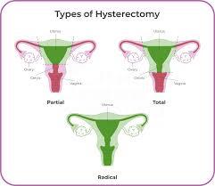 معرفی بهترین جراحان هیسترکتومی در تهران و توصیه های لازم