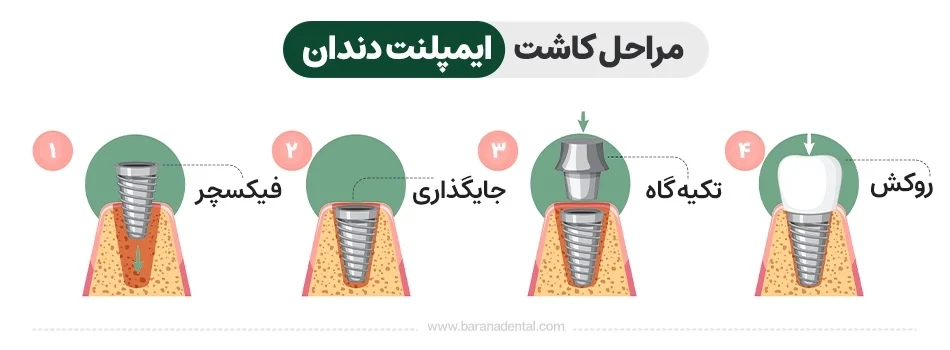 ایمپلنت بررسی صفر تا مراحل ایمپلنت دندان