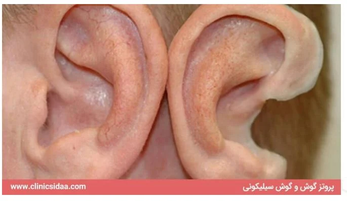 پروتز گوش برای افرادی با کم شنوایی : راهی برای بهبود عملکرد روزانه